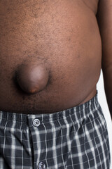 A brown skin man with umbilical hernia, close view of a swollen navel from an intestinal hernia,...