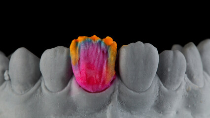 excellent bright ceramics on the future crown, on the model and a black background