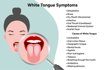 Fototapeta premium White tongue symptoms, medical information