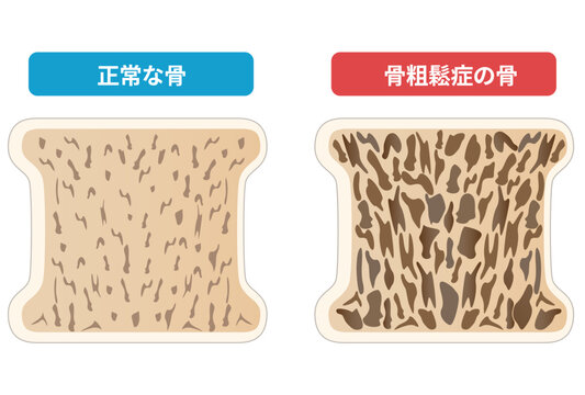 骨粗鬆症と正常な骨の断面図の比較