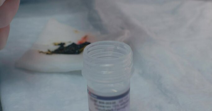 In surgery, a piece of tumor falls into a jar of formaldehyde from the surgeon's scissor. After removing the tumor, the surgeon takes a sample of tumor tissue for histological examination.
