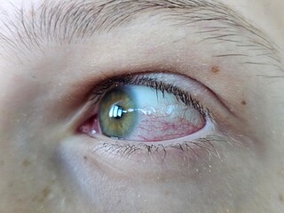 Close-Up of a Human Eye With Red Blood Vessels