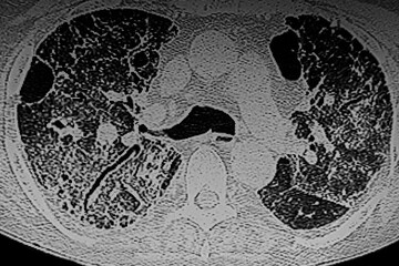 CAT- Scan of interstitial lung disease secondary to scleroderma. Medical themes