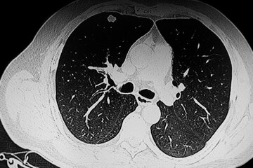 Chest Ct Scan Solid middle lobe nodule