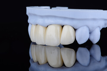 High-quality naturally dental single crowns made of zirconium for fixation to the frontal teeth of upper jaw. © gorynvd