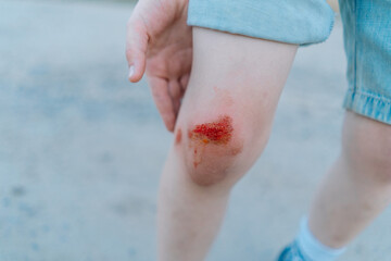 The child is wearing shorts and is standing on a light-colored surface. The image captures the raw...