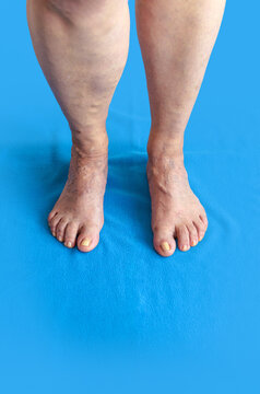 "Pitting Edema" Images – Browse 19,234 Stock Photos, Vectors, and Video