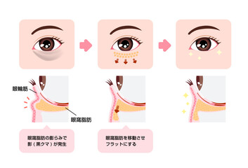 目のくま（黒クマ) の除去手術 図解イラスト (ハムラ法・裏ハムラ法)
