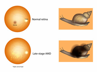 Age-Related Macular Degeneration or AMD. Late-stage AMD and Normal retina. Medical illustration 
