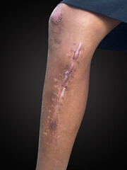 Raised scars caused by surgery.