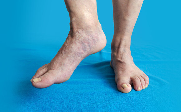 V&aacute;rices y telangiectasias. Vasos sangu&iacute;neos peque&ntilde;os y dilatados en pies de mujer mayor. 