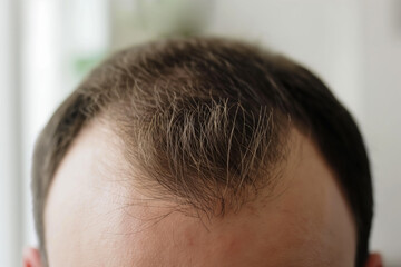 Obraz premium Close-up of a man's head. Hairstyle with receding hairline. Alopecia in men. Self-acceptance, body positivity