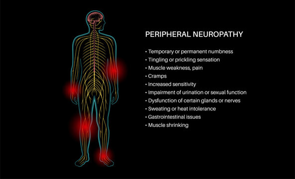 Peripheral neuropathy medical poster
