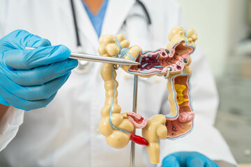 Ulcerative Colitis. Intestine, appendix and digestive system, doctor holding anatomy model for...