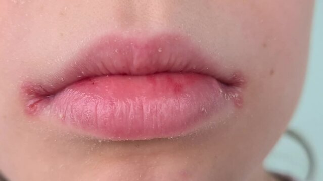 Close Up Of Dry, Chapped Lips With White Flakes