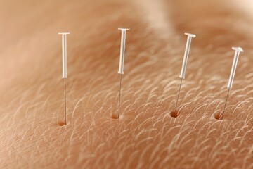 Acupuncture treatment, needles on person back skin, closeup detail