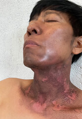 Burns on the neck from radiation, cancer treatment. select focus.