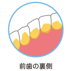 前歯の裏側に溜まった歯垢　歯磨き　磨き残し