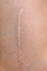 Close up of cyanotic keloid scar caused by surgery and suturing