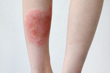 Close-up of a person's leg with erythema after a tick bite, showing a red rash