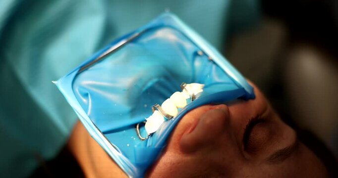 Dentist processes teeth of female patient with airstream to get rid of saliva. Specialist installs veneers on natural teeth of client slow motion