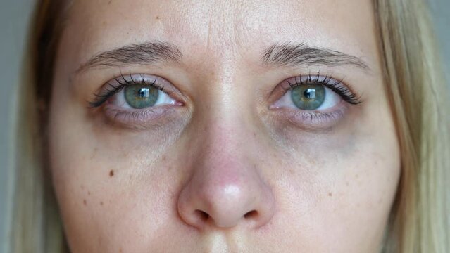 A sad young blonde woman with dark circles under her eyes on a grey background. Pale skin, bruises under the eyes are caused by fatigue, lack of sleep, insomnia, stress, disease