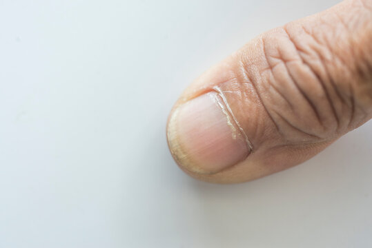 Finger nails infected with fungus Image of the concept of health care with illnesses of the body