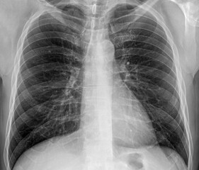 "Medical imagery, lung health, x-ray, radiology and anatomy, showcasing the human chest, healthcare practices.".