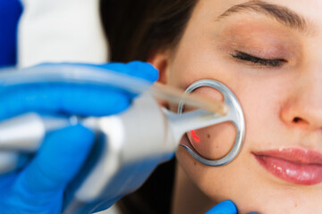Process of facial CO2 laser resurfacing. Cosmetologist removes wrinkles and scars using laser from...
