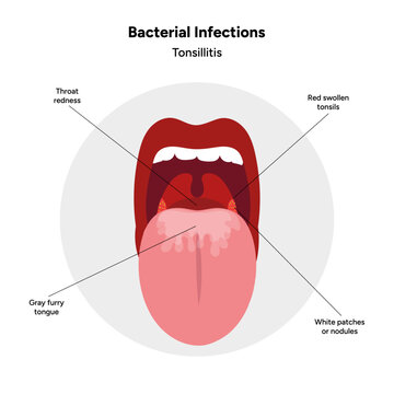 Viral bacterial infection, sore throat, tonsillitis medical diagram 