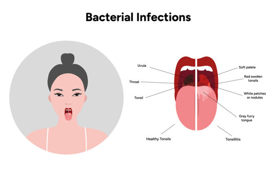 Woman with open mouth, viral bacterial infection, sore throat, tonsillitis, and healthy tonsils medical diagram 