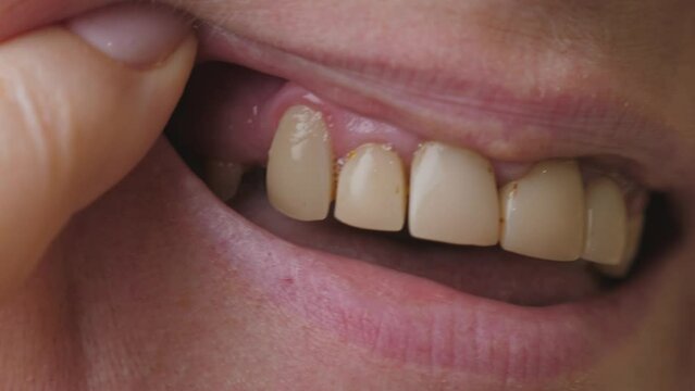 Unrecognizable woman with bad broken teeth. Female mouth with damaged and cracked tooth. Closeup