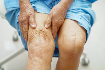 Asian elderly woman patient show her scars surgical total knee joint replacement Suture wound...