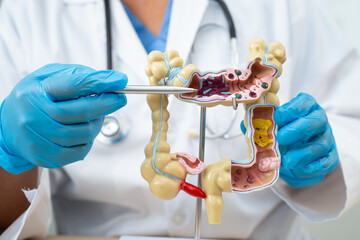 Ulcerative Colitis. Intestine, appendix and digestive system, doctor holding anatomy model for...