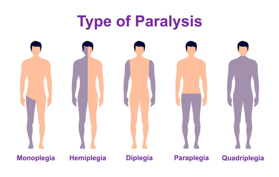 Paralysis types, spinal cord injury. Stroke, tumor, nerve damage brain. Face palsy.
