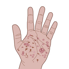 Eczema or allergy rash red on hand, itching from urticaria or atopic dermatitis, illustration on white background