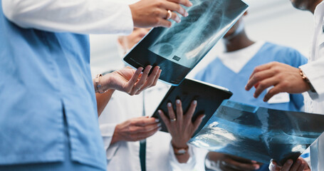 Doctors, xray and nurse discussion in clinic, professional consultation and teamwork collaboration for patient results. Radiologist, chest diagnosis and people conversation, research and healthcare