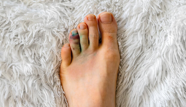 Male leg with a bruise on the toe.