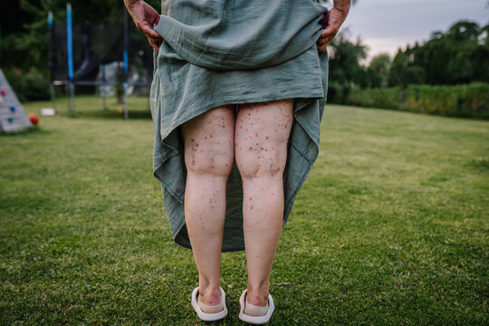 A woman standing outdoors, lifting her dress to show a rash on the back of her legs caused by Human Parvovirus (Parvovirus B19).