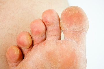 Fungal disease of the feet, legs, skin of the feet. Fungal infection, mycosis of the feet.