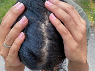 man have a dandruff and hair loss