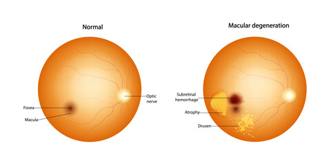 Normal retina and Macular degeneration: Drusen, Atrophy, Subretinal hemorrhage. 