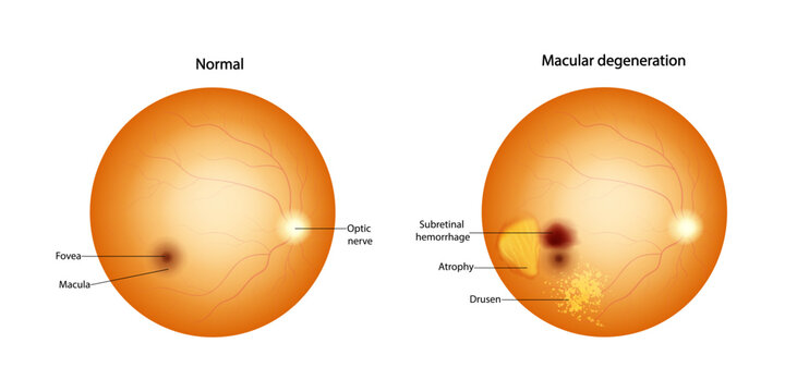 Normal retina and Macular degeneration: Drusen, Atrophy, Subretinal hemorrhage. 