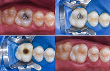 amalgam filling safe repacment with light cure esthetic composite filling