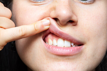 Woman touching her sore lip, swollen gums after dental treatment