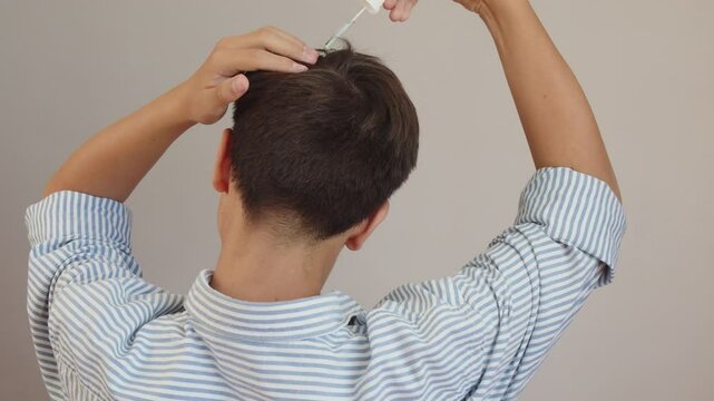 Close-up. A teenager applies the serum with a pipette to the back of the head, to the skin between the hair. Treatment and prevention of dandruff and seborrhea. Concept of caring for problematic scalp