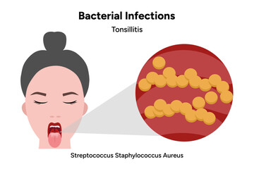 Bacterial infection tonsillitis 