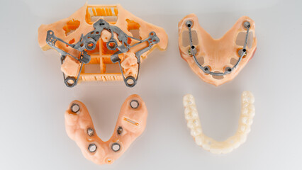 kit for total dental implantation of zygomatic templates, a beam on the model and a temporary...
