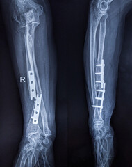 X ray image of forearm showing prosthesis failure of radius fracture 