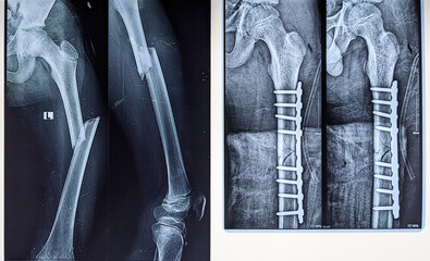 X ray image of femur fracture and fixation of the fracture by dynamic plate and screws 